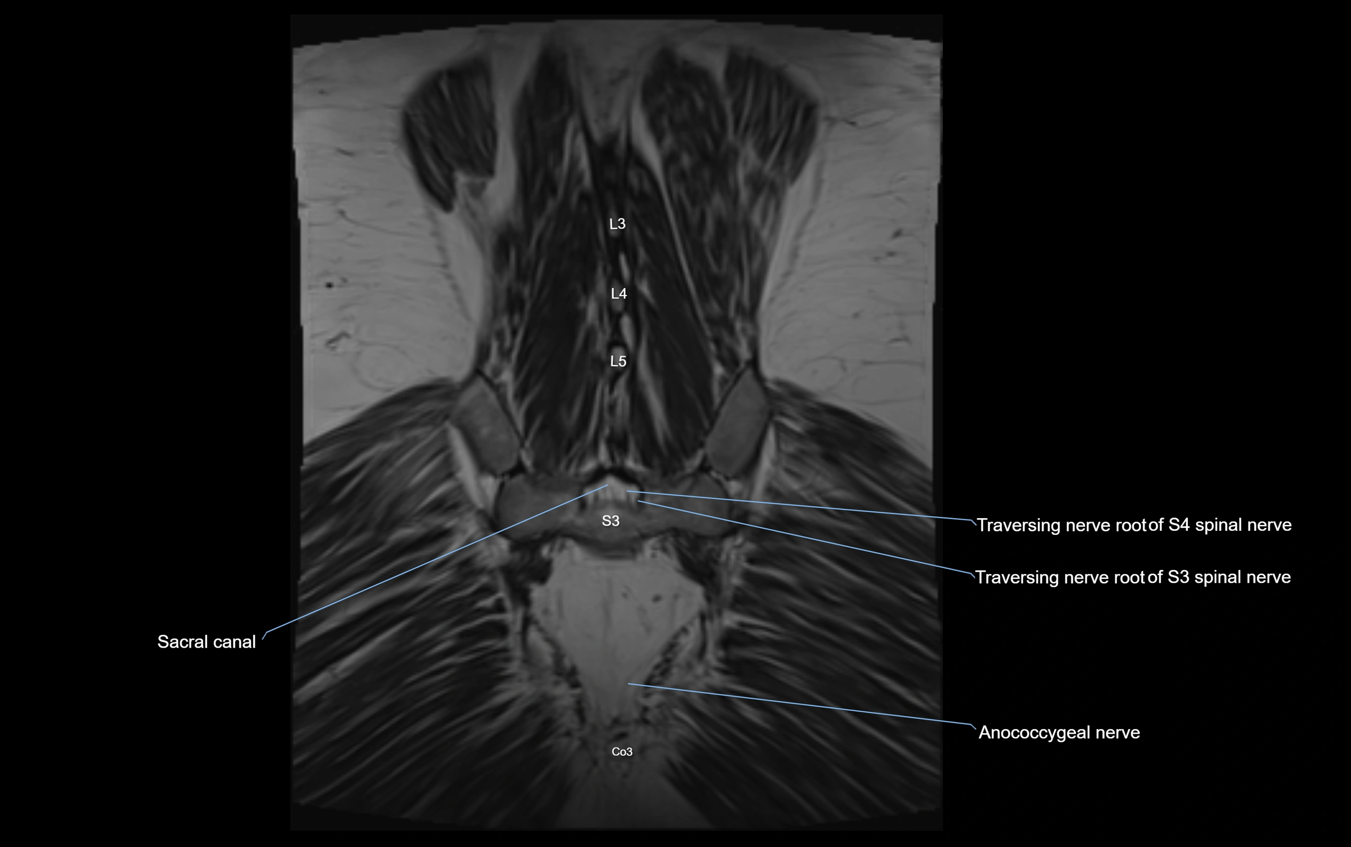 MR lumbosacral plexus cross sectional anatomy 3T  radiology  image-img-09001-00073.webp